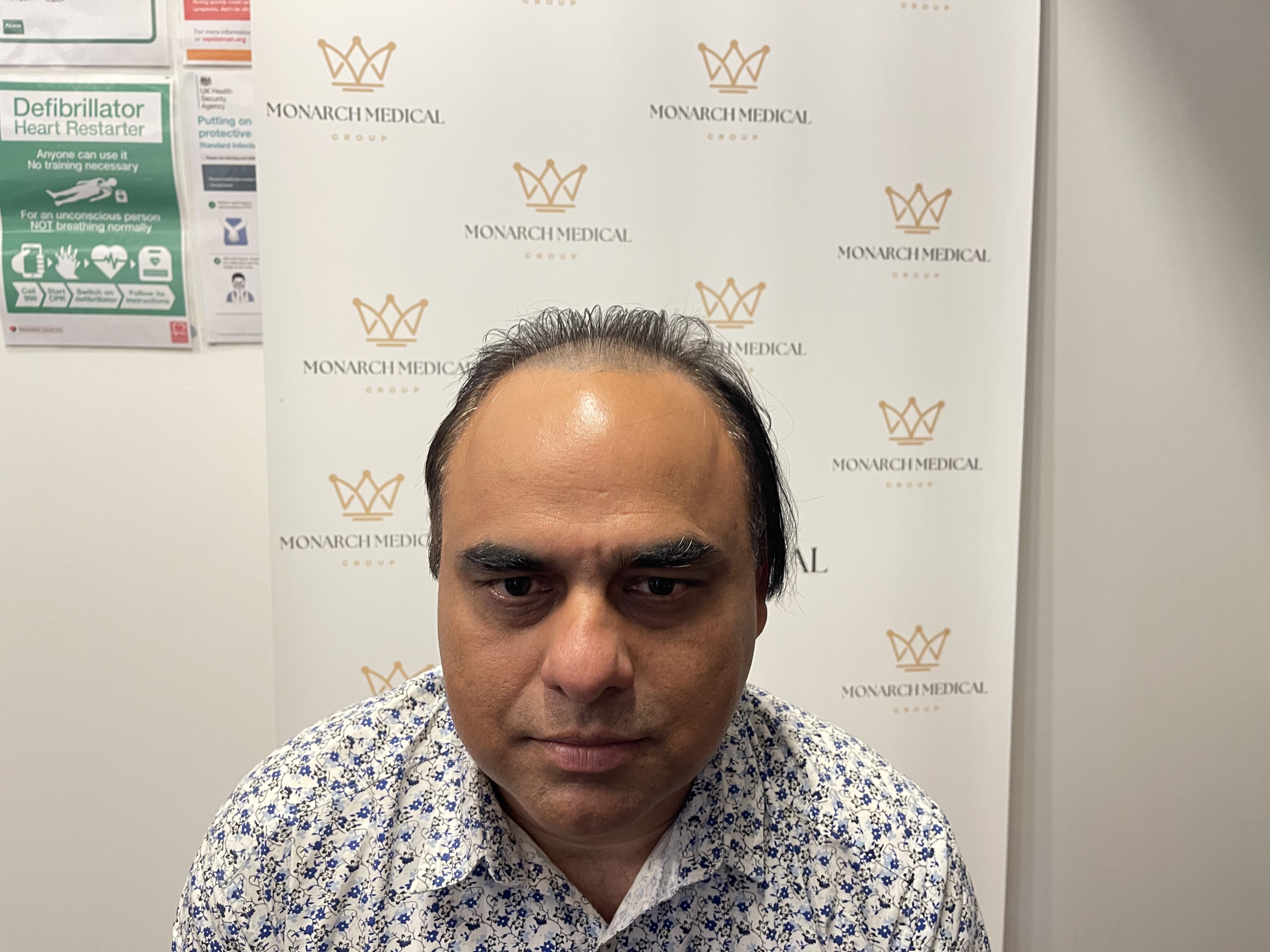 Nishant receded hairline and crown restoration case study